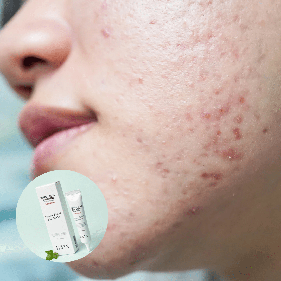 Centella CICA Saves Acne-Prone Skin - Fresh Mask Korean Beauty