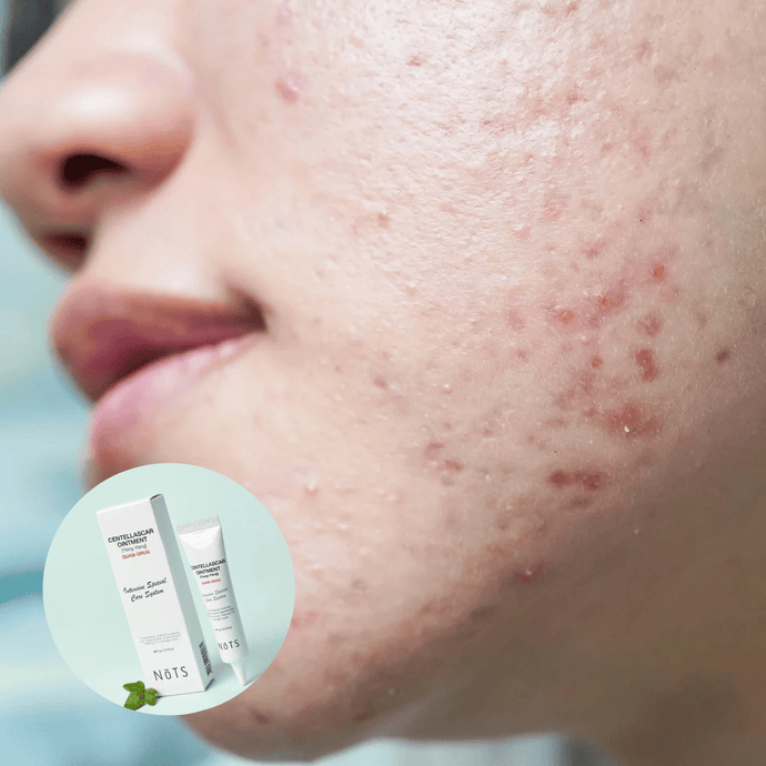 Centella CICA Saves Acne-Prone Skin