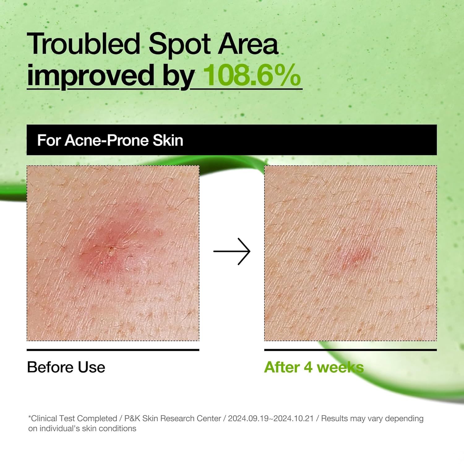 [Anua] Azelaic 10 Hyaluron Redness Soothing Pad (90 pads) - Fresh Mask Korean Beauty